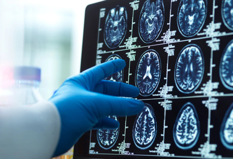 huevos alzheimer alimentacion